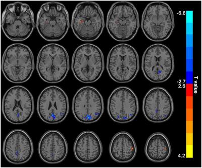Alterations of Spontaneous Brain Activity in Hemodialysis Patients